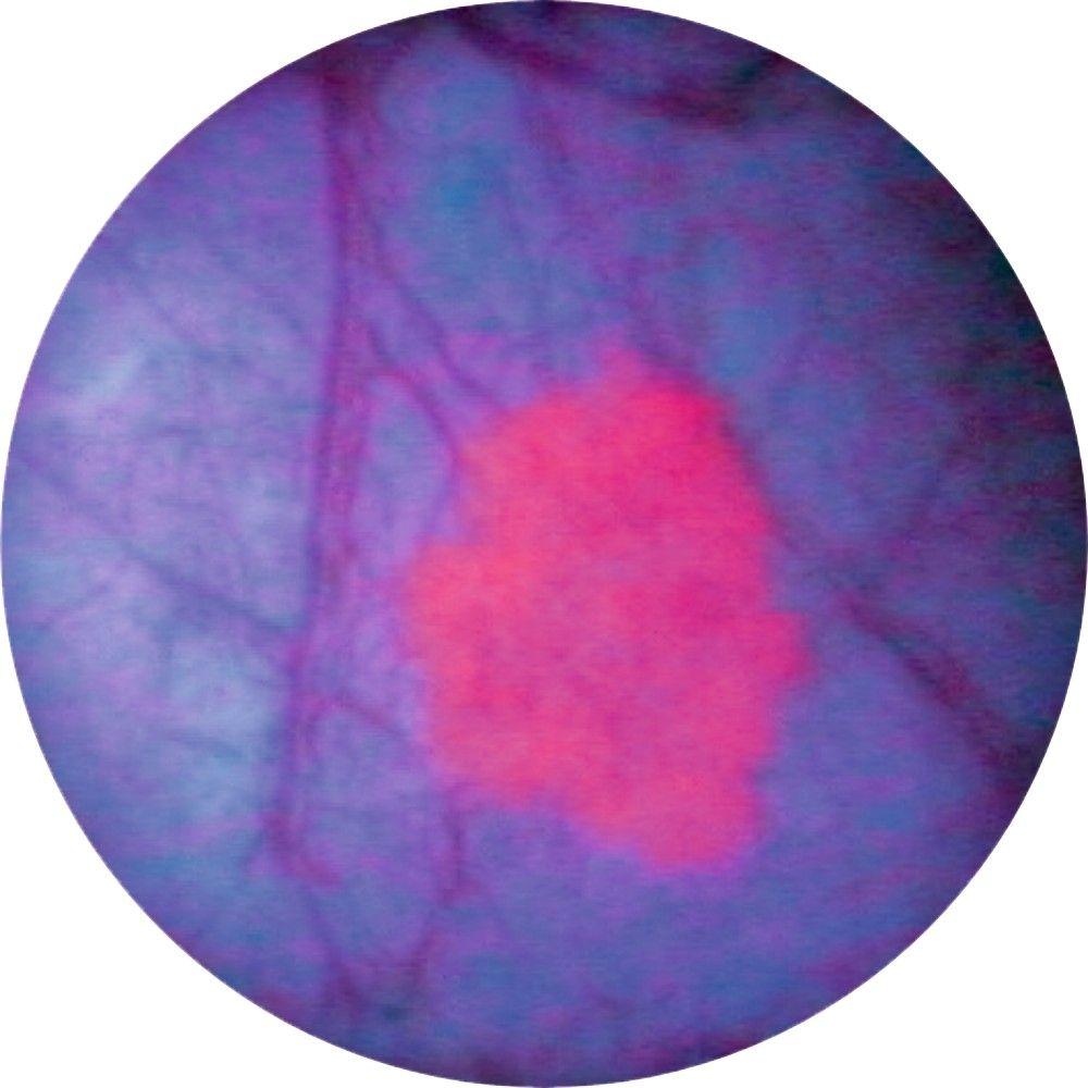 Bladder seen through a cystocope under blue light